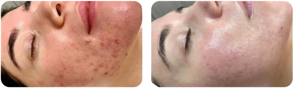 hydrafacial-avant-apres