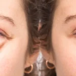 Acide hyaluronique cernes : prix, résultats et durée des effets acide-hyaluronique-cernes