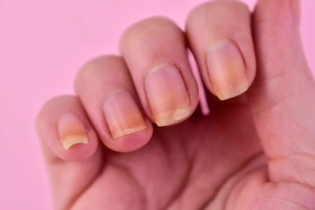 infiltration-ongle