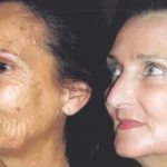Peeling phénol avant après : résultats spectaculaires et à quoi s’attendre peeling-phenol-avant-apres