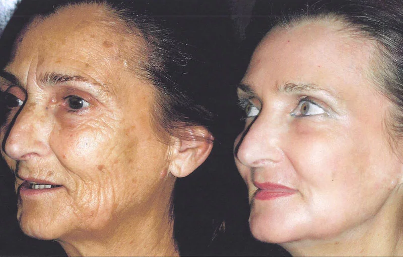 peeling-phenol-avant-apres