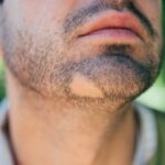 Pelade barbe : comment traiter naturellement la perte de poils pelade-barbe