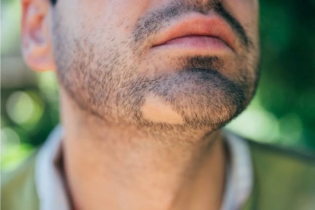pelade-barbe