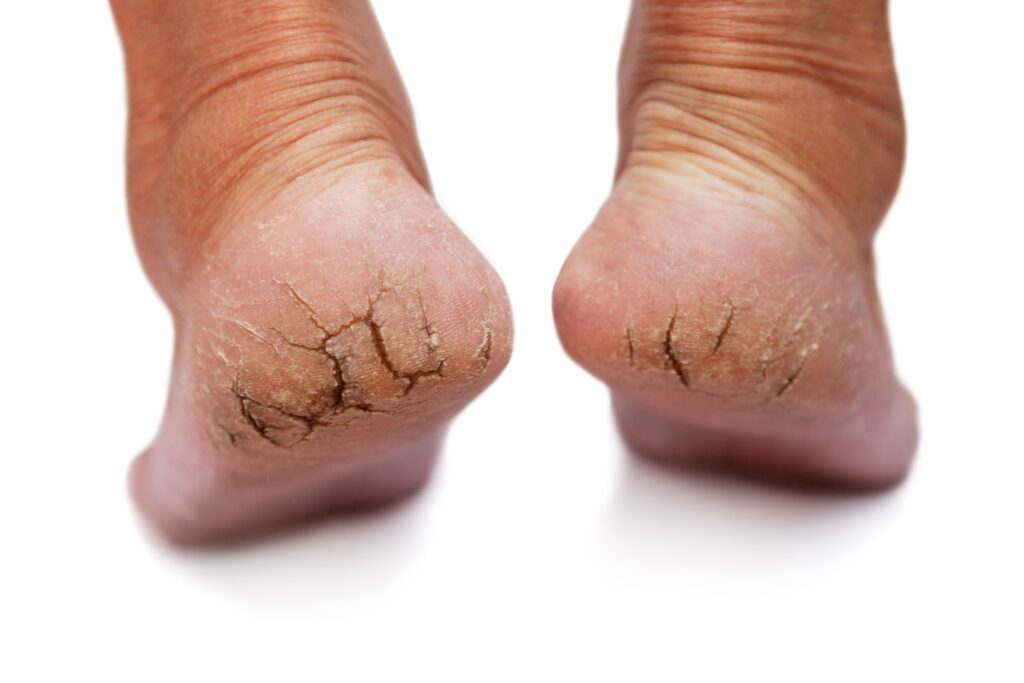 remede-miracle-corne-aux-pieds