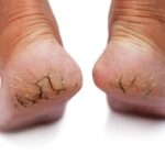 Remede miracle corne aux pieds : traitements simples et rapides remede-miracle-corne-aux-pieds