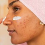 Dentifrice pour les boutons : bonne ou mauvaise idée pour la peau ? dentifrice-pour-les-boutons