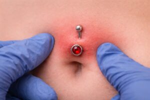 piercing-infecte-nombril
