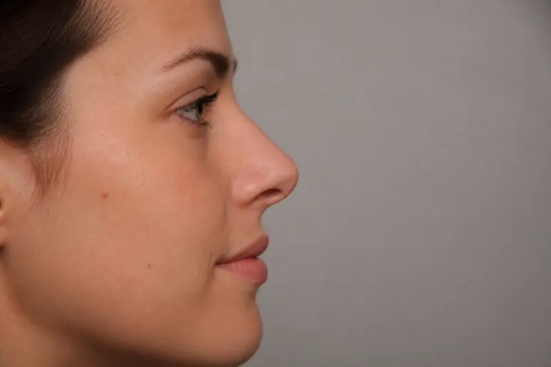Profil d'un visage montrant l'alignement vertical entre le front, le nez et le menton fuyant.