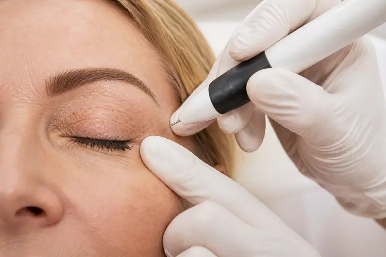 Mains d'un médecin utilisant un stylo plasma pour une blépharoplastie médicale des paupières